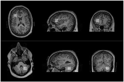 Relationship Between MR Spectroscopy-Detected Glutamatergic Neurometabolites and Changes in Social Behaviors in a Pilot Open-Label Trial of Memantine for Adults With Autism Spectrum Disorder